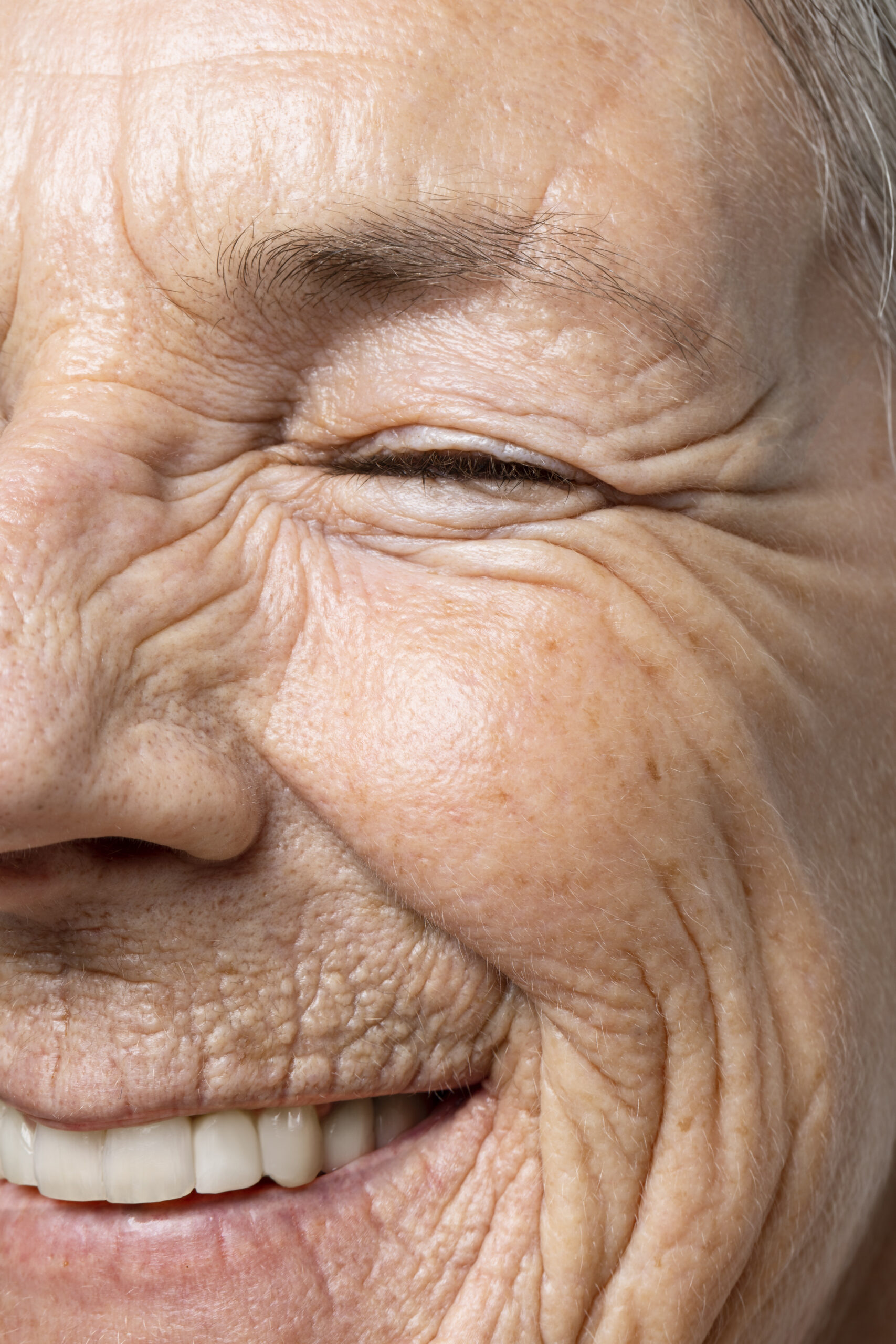 Arrugas de expresión